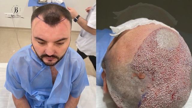 Hair Transplant And Restoration / пересадка волос