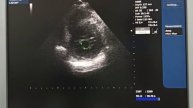 После кардиоверсии мучительно пытаюсь оценить тяжесть митрального стеноза