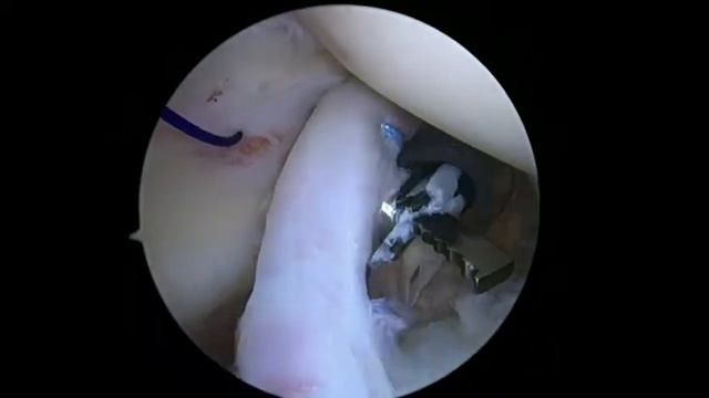 R Shoulder biceps tenodesis for SLAP lesion 6.18.20 LS