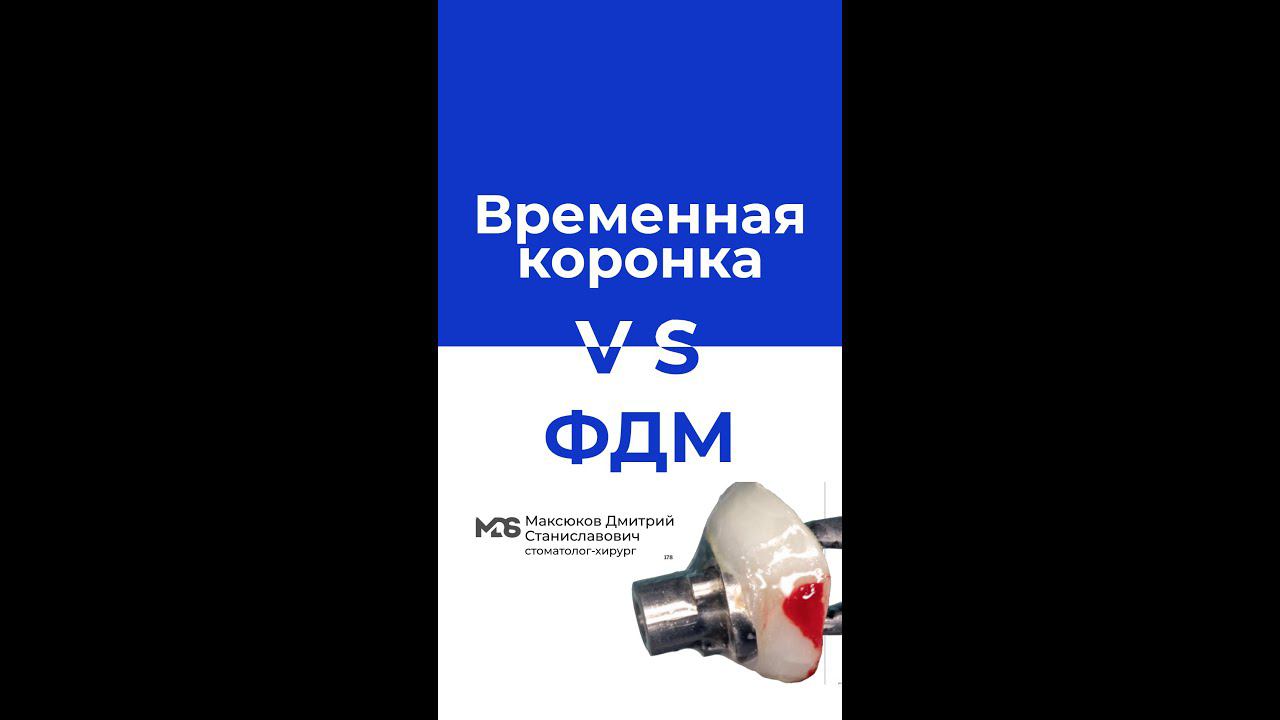 Что лучше при одномоментной имплантации временная коронка или ФДМ ?