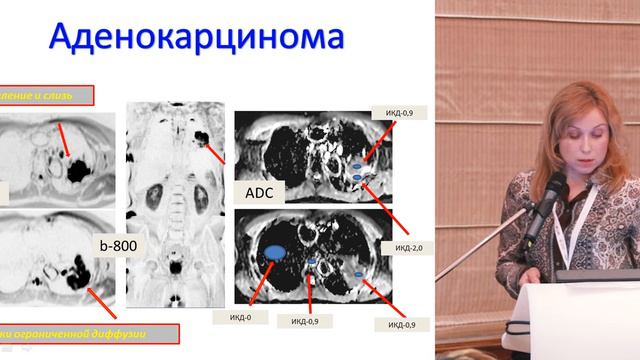 МРТ ДВИ (DWI) в диагностике очаговых поражений органов грудной клетки