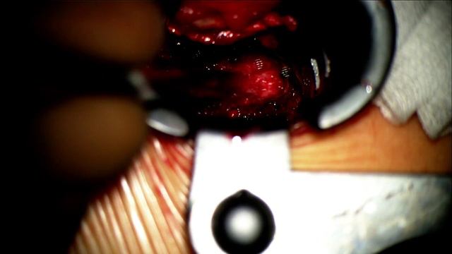Microdecompression In Lumbar Foraminal Stenosis. Микродекомпрессия при фораминальном стенозе.