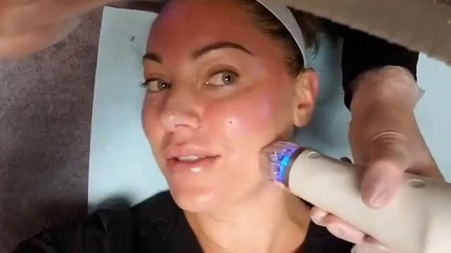 Secret RF Microneedling at Spa Medical