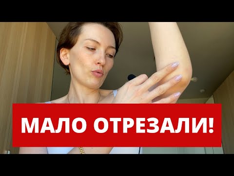 ВСЕ ПЛОХО 3 МЕСЯЦА ПОДТЯЖКА ЖИВОТА И РУК ДО И ПОСЛЕ БЕЗ ПЛАСТЫРЕЙ АБДОМИНОПЛАСТИКА.mp4