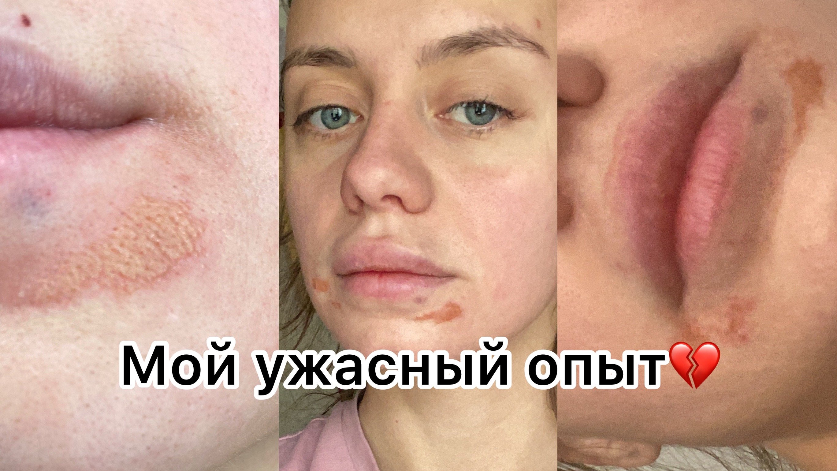 УВЕЛИЧЕНИЕ ГУБ. МОЙ УЖАСНЫЙ ОПЫТ. ВСЯ ПРАВДА.
