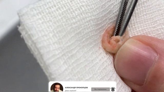 Атерома. Вне организма человека. Капсула и творог.