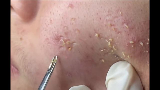 Remoção de cravo 2021 - Pimple Popping 2021- Blackhead Removal 008