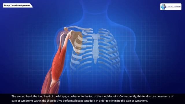 Biceps Tenodesis  Practice Potential