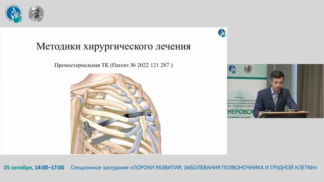 Малоинвазивная торакопластика при асимметричной воронкообразной деформации грудной клетки у детей.