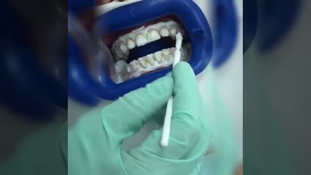 Отбеливание зубов в клинике "Стоматология на Пресне"
