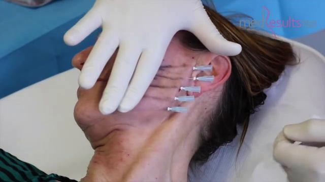 Med Results - ASsufil HD PDO Threads