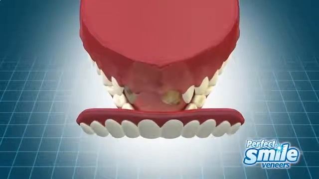 виниры виниры на зубы Perfect Smile veneers