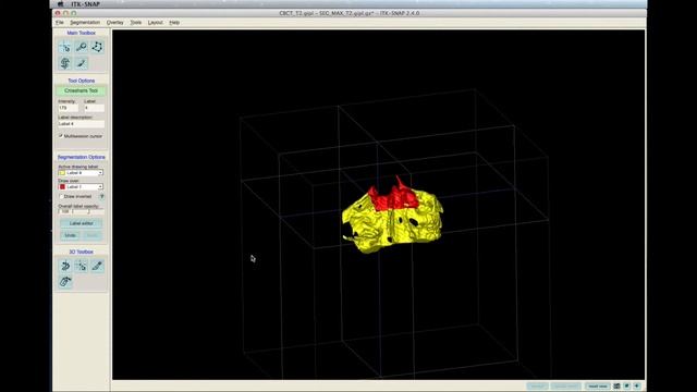 3J Construct Maxilla Posterior Region of Reference and Applying Voxel-based Registration