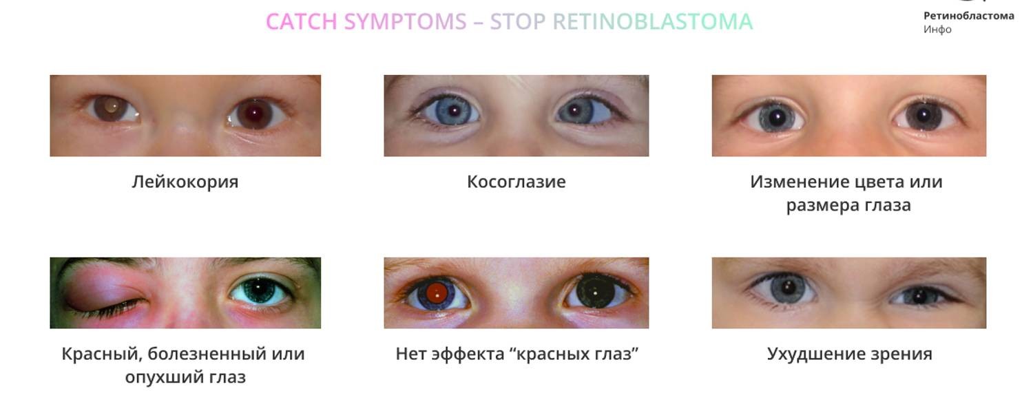 РетинобластомаИнфо