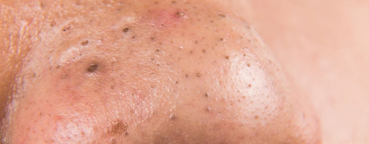 Шок! Сборник видео борьбы с прыщами и угрями.