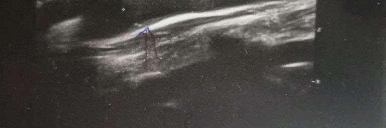 Борьба с развивающимся атеросклерозом