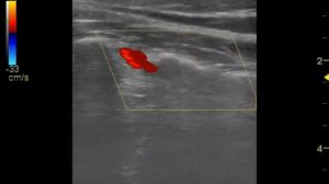 УЗИ позвоночной артерии