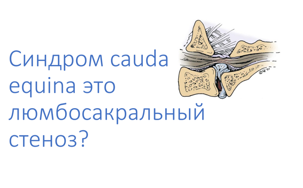Люмбосакральный стеноз