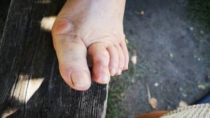 как вылечить ШИШКУ НА БОЛЬШОМ ПАЛЬЦЕ НОГИ Отзыв MatrixOsteo