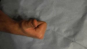 Отдаленные результаты после восстановления сухожилий глубоких сгибателей 2-3-4-5 пальцев во II зоне