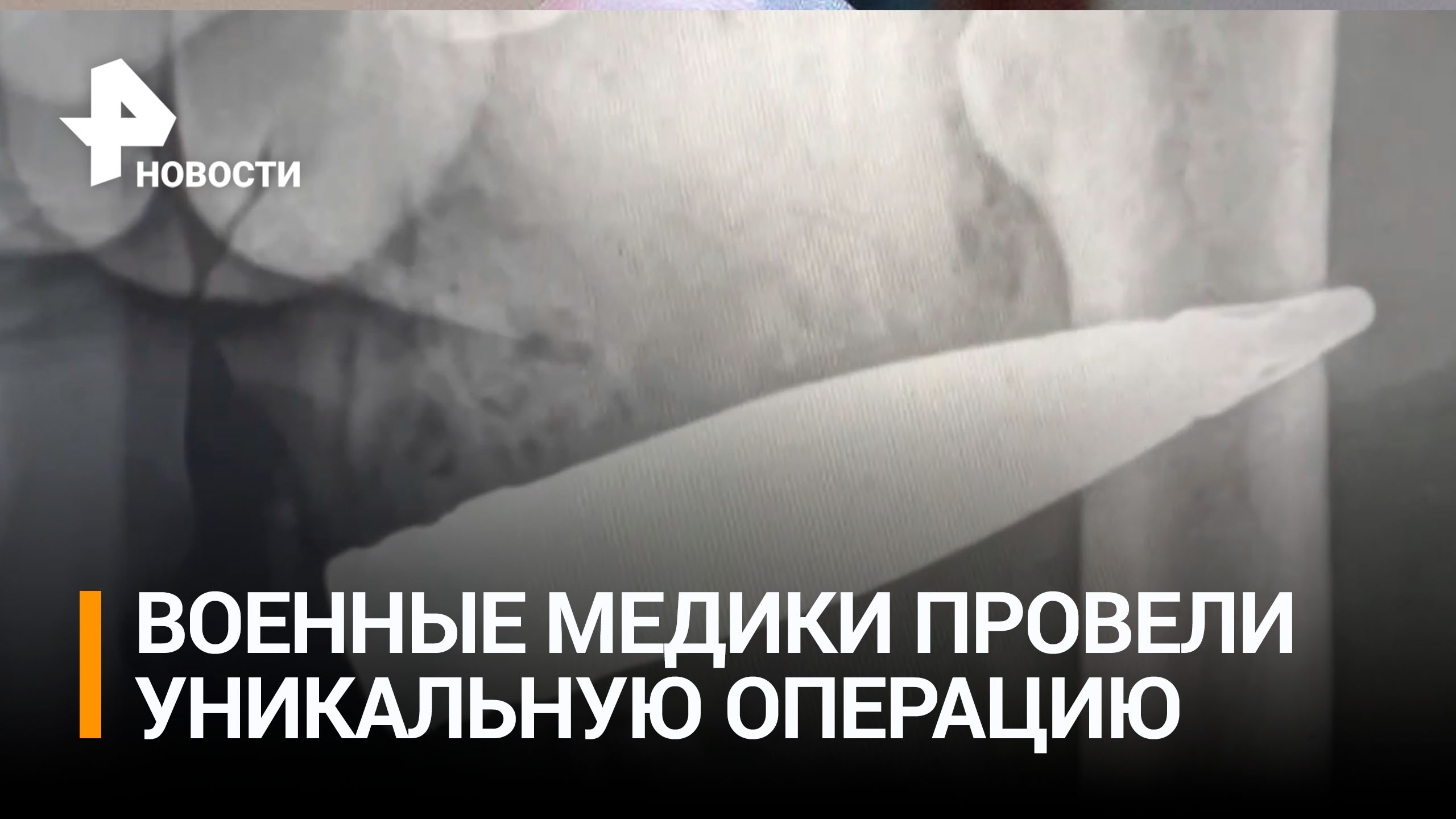 Медики в зоне спецоперации извлекли из солдата неразорвавшийся снаряд / РЕН Новости