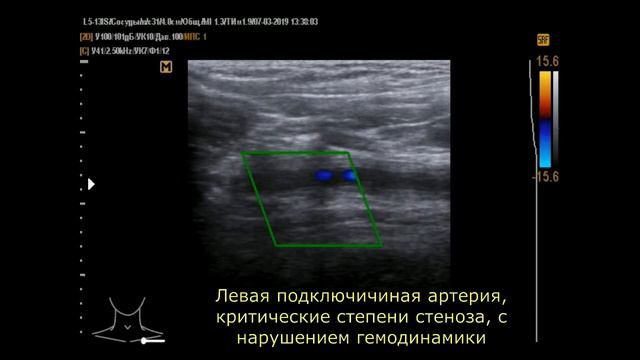 Синдром Такаясу (аортоартериит, синдром отсутствия пульса итд., 2 случая.)