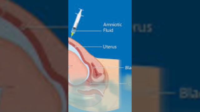 Amniocentesis Process