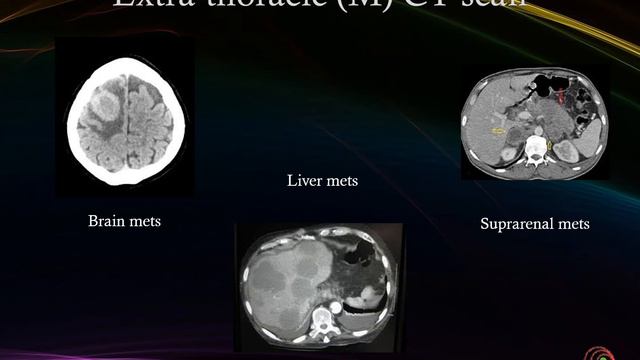 Lung cancer, presentation and diagnostic tools review