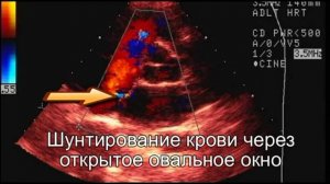 Открытое овальное окно, Эхо-КГ