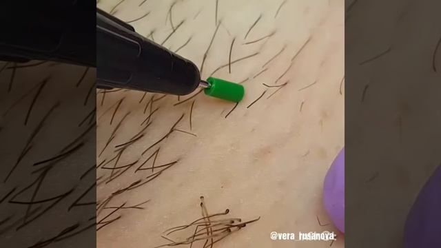 Электроэпиляция