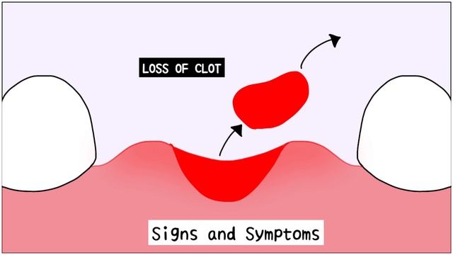Dry Socket (After tooth extraction): All you need to know смотреть онлайн