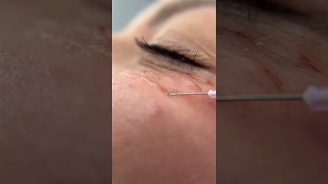 Итак, что дает биоревитализация, какого результата можно добиться: #косметологмосква смотреть онлайн