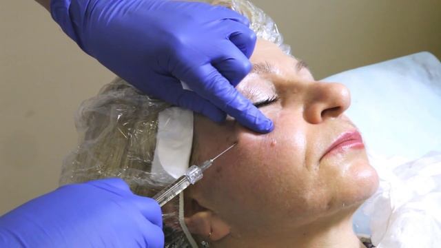 Мастер-класс по Софтфиллингу канюлями смотреть онлайн