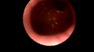 Гастроэндоскопия пищевода и желудка