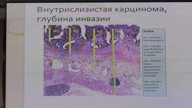 06 Крайнова ЕА Патогистологические критерии диагностики Пищевода Барретта смотреть онлайн