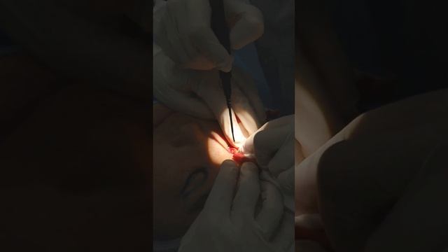 Блефаропластика. Европеизация век смотреть онлайн