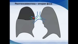 Центральный рак легкого - Рентген