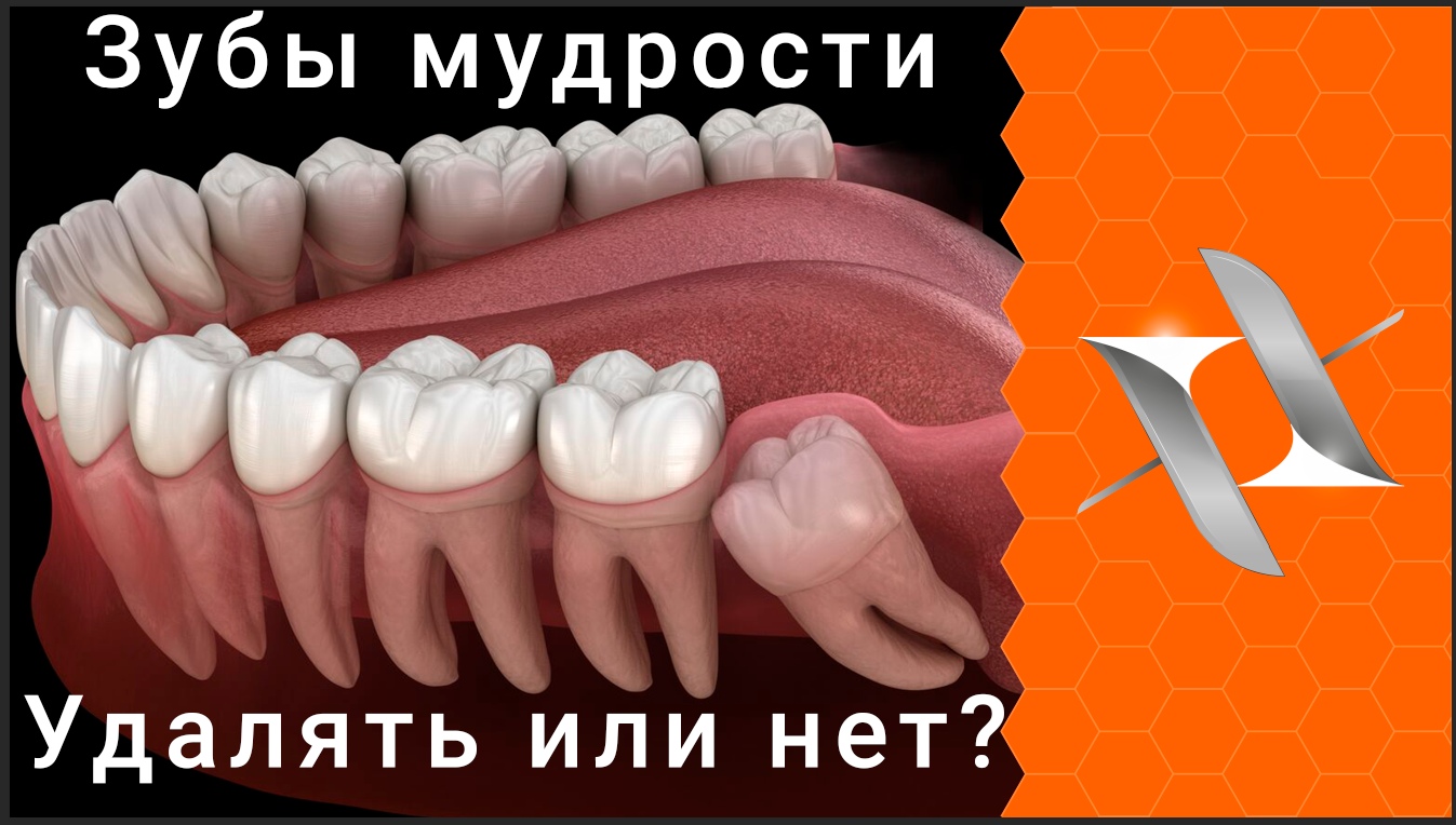 ЗУБЫ МУДРОСТИ: 5 причин удалить и 4 - оставить. Взгляд ортодонта.