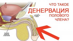 Что такое Денервация полового члена? / Доктор Черепанов