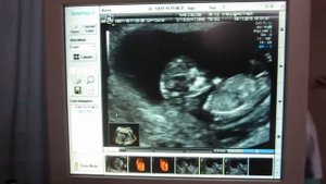 Узи 3D - 10 неделя беременности.
