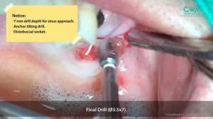 Simultaneous implant plancement with sinus lift