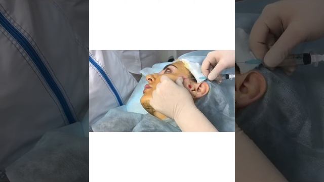 Подтяжка лица нитями Аптос Экселенс визаж