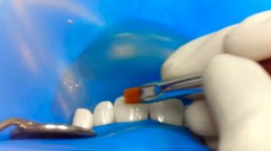 Эстетическая реставрация передних зубов