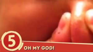 Top 10 Satisfying Pimple Popping Videos