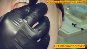 Установка формирователя десны 25. Кейс#13.