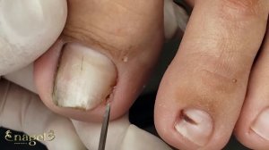 UNHA MUUUITO ENCRAVADA/SEM SANGRAMENTO #ingrowntoenail #nails