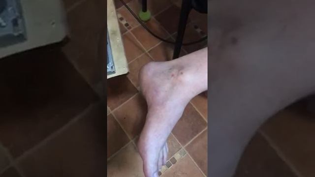 Лечение шпоры в домашних условиях. 2 часть смотреть онлайн