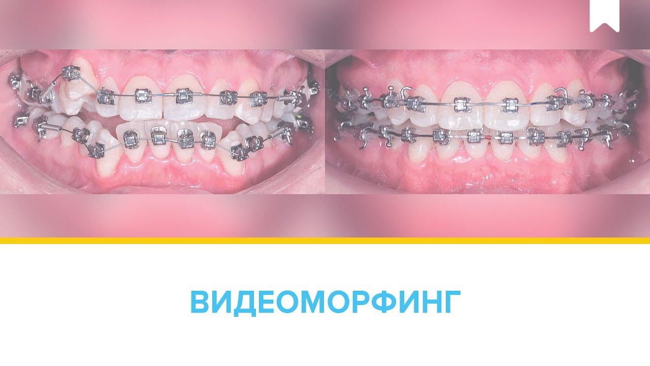 Лечение скученности с удалением у пациентки 35 лет на цифровых брекетах