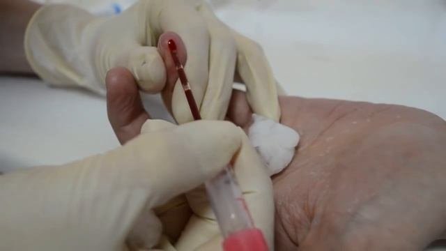 Скорость оседания эритроцитов (СОЭ)