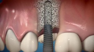 MIS Implants C1 Implant Movie in 3D animation